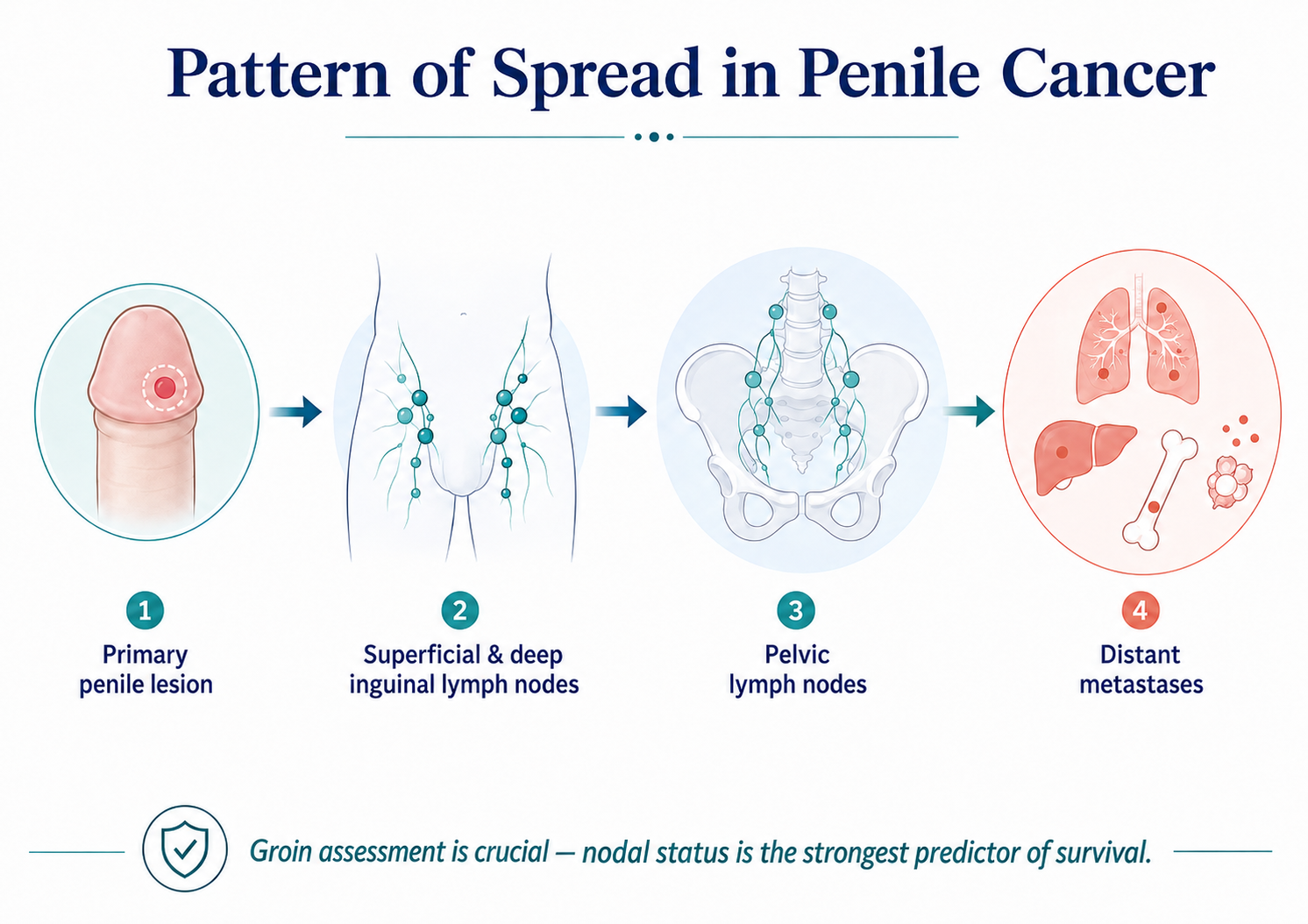 Pattern of spread in penile cancer